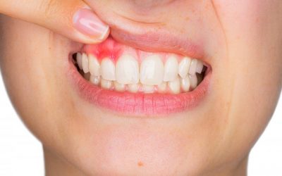 Cómo comienza la enfermedad de las encías