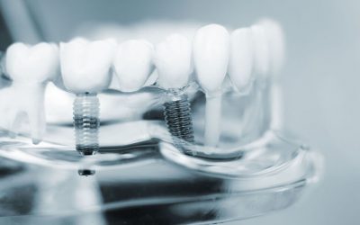 Cirugía de implantes dentales, cuidados básicos y postoperatorio