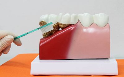 Enfermedad de las encías y cáncer