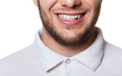 Motivos para sustituir dientes perdidos